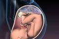 Отлепване на плацентата в ранна бременност: причини, последствия и има ли шанс да се спаси бебето