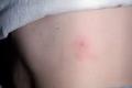 Детето беше ухапано от комари: какво да правя?