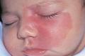 Why do birthmarks appear in a child?